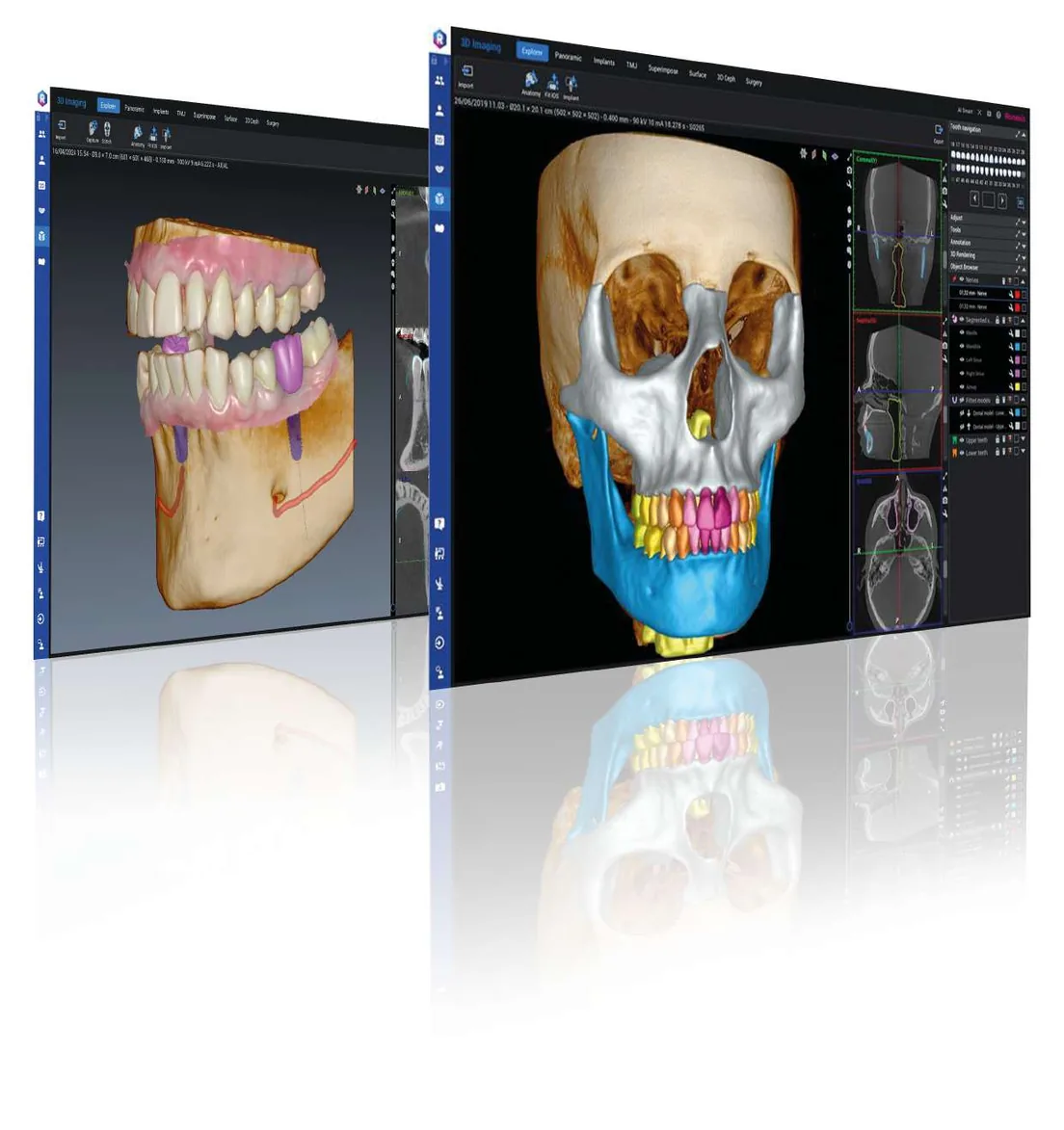 Software Planmeca Romexis exibindo tomografia 3D e planejamento digital